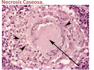 Necrosis Caseosa.
 