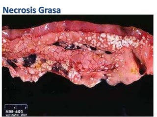 Necrosis Grasa
 