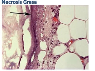 Necrosis Grasa
 