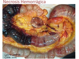 Necrosis Hemorrágica
 