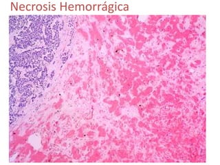 Necrosis Hemorrágica
 
