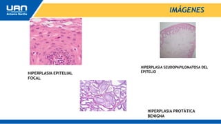 IMÁGENES
HIPERPLASIA SEUDOPAPILOMATOSA DEL
EPITELIO
HIPERPLASIA EPITELIAL
FOCAL
HIPERPLASIA PROTÁTICA
BENIGNA
 