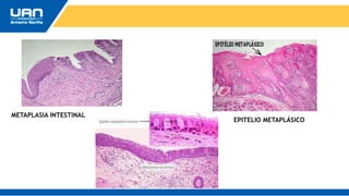 METAPLASIA INTESTINAL
EPITELIO METAPLÁSICO
 