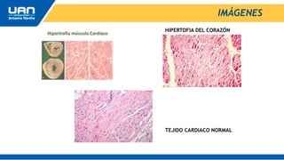 IMÁGENES
HIPERTOFIA DEL CORAZÓN
TEJIDO CARDIACO NORMAL
 