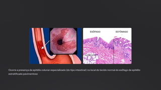 Ocorre a presença de epitélio colunar especializado (do tipo intestinal) no local do tecido normal do esôfago de epitélio
estratificado pavimentoso
 