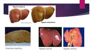 Esteatose hepática Fígado normal Fígado cirrótico
 