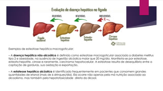 Exemplos de esteatose hepática macrogoticular:
– A doença hepática não-alcoólica é definida como esteatose macrogoticular associada a diabetes mellitus
tipo 2 e obesidade, na ausência de ingestão alcóolica maior que 20 mg/dia. Manifesta-se por esteatose,
esteato-hepatite, cirrose e raramente, carcinoma hepatocelular. A esteatose resulta de desequilíbrio entre a
captação de gorduras, sua oxidação e exportação.
– A estateose hepática alcóolica é identificada frequentemente em pacientes que consomem grandes
quantidades de etanol (mais de 6 drinques/dia). Ela ocorre não apenas pela má nutrição associada ao
alcoolismo, mas também pela hepatotoxicidade direta do álcool.
 
