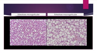 Esteatose microgoticular Esteatose macrogoticular
 