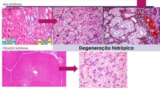 Anatpat-UNICAMP PT Nextews.com
RIM NORMAL
FÍGADO NORMAL Degeneração hidrópica
 