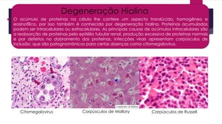 Degeneração Hialina
 O acúmulo de proteínas na célula lhe confere um aspecto translúcido, homogêneo e
eosinofílico, por isso também é conhecida por degeneração hialina. Proteínas acumuladas
podem ser intracelulares ou extracelulares. As principais causas de acúmulos intracelulares são
a reabsorção de proteínas pelo epitélio tubular renal, produção excessiva de proteínas normais
e por defeitos no dobramento das proteínas. Infecções virais apresentam corpúsculos de
inclusão, que são patognomônicos para certas doenças como citomegalovirus.
Citomegalovirus Corpúsculos de Russell
Corpúsculos de Mallory
 