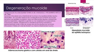 Degeneração mucoide
anatpat.unicamp.br
Adenocarcinoma gástrico com células em anel de sinete
"Degeneração Mucóide Epitelial" (FARIA et alii, in BOGLIOLO, 1978; BARRETO NETO et
alii, 1984):
Aumento intracelular e/ou intersticial de mucinas e mucopolissacárides neutros
(Eosinofilia! ¹ do conceito clássico) em consequência do aumento da função
secretora dos epitélios mucíparos, vistos nas inflamações agudas catarrais dos
sistemas respiratório, digestório e genital; ou nas neoplasias mucossecretoras
(Carcinoma colóide, cistadenoma e cistadenocarcinoma mamários e
gastrointestinais) onde a falta de acesso aos ductos resultam em acúmulo
intracelular ("Célula em anel de Sinete!") ou mesmo intersticial de mucina.
Hiperplasia mucoide
do epitélio brônquico
 
