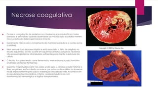 Necrose coagulativa
 Ocorre a coagulação de proteínas no citoplasma e as células ficam todas
borradas e sem nitidez quando observadas ao microscópio as células morrem,
mas sua estrutura básica permanece intacta.
 Geralmente não ocorre o rompimento da membrana celular e o núcleo some
(cariólise).
 Nem sempre é um processo rápido e está associada a falta de oxigênio no
tecido (isquemia), só não ocorre em isquemia cerebral, porque os neurônios
não possuem proteínas intracelulares suficientes para manter a estrutura da
célula.
 O tecido fica parecendo carne ferventada, meio esbranquiçado (também
chamado de tecido fantasma).
 Isquemia / reperfusão ocorre nos casos onde após a necrose celular retorna o
fluxo sanguíneo, então a lesão acontece por outros motivos além da isquemia
inicial, especialmente pelo cálcio e liberação de radicais livres. Acontece em
revascularizações miocárdicas, infartos cerebrais isquêmicos com
transformação hemorrágica e órgãos transplantados.
USMLE Press
 