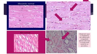 Rim normal
Observem que
o citoplasma
da célula está
coagulado
(ghost cell) mas
o núcleo está
ausente ou
picnótico.
 