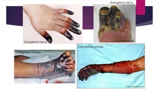 Comunidades.net
James Heilman, MD
Comunidades.net
Gangrena úmida
Gangrena úmida
Gangrena seca
Gangrena seca
 