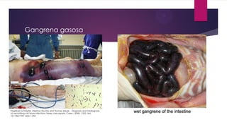 Engelbert Schröpfer, Stephan Rauthe and Thomas Meyer. - Diagnosis and misdiagnosis
of necrotizing soft tissue infections: three case reports. Cases J 2008, 1:252. doi:
10.1186/1757-1626-1-252
Gangrena gasosa
http://medicineisnotmerchandise.tumblr.com
 