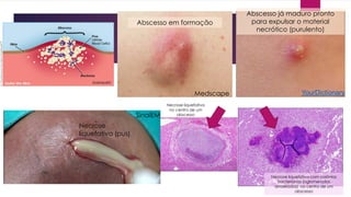 KidsHealth
Medscape
SinaiEM
Necrose
liquefativa (pus)
Necrose liquefativa
no centro de um
abscesso
Necrose liquefativa com colônias
bacterianas (aglomerados
arroxeados) no centro de um
abscesso
Abscesso em formação
Abscesso já maduro pronto
para expulsar o material
necrótico (purulento)
 