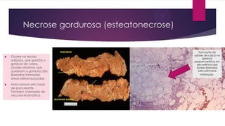 Necrose gordurosa (esteatonecrose)
 Ocorre no tecido
adiposo, que guarda a
gordura do corpo.
Lipases (enzimas que
quebram a gordura) são
liberadas formando
áreas esbranquiçadas.
 Mais comum em casos
de pancreatite.
Também chamada de
necrose enzimática.
Formação de
sabões de cálcio na
gordura
peripancreática em
decorrência das
lipases liberadas
pelo pâncreas
inflamado.
 