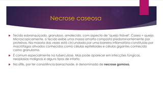 Necrose caseosa
 Tecido esbranquiçado, granuloso, amolecido, com aspecto de "queijo friável". Caseo = queijo.
Microscopicamente, o tecido exibe uma massa amorfa composta predominantemente por
proteínas. Na maioria das vezes está circundada por uma barreira inflamatória constituída por
macrófagos ativados conhecidos como células epitelioides e células gigantes conhecido
como granuloma.
 É comum especialmente na tuberculose. Mas pode aparecer em infecções fúngicas,
neoplasias malignas e alguns tipos de infarto.
 Na sífilis, por ter consistência borrachoide, é denominada de necrose gomosa.
 