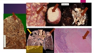 Study.com
medicalschool
The Center for Food Security and Public Health - Iowa State University
Radiopaedia
A necrose caseosa quando
atinge os brônquios é
eliminada gerando as
cavernas tão comuns na
tuberculose pulmonar.
 