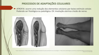 PROCESSOS DE ADAPTAÇÕES CELULARES
 ATROFIA: ocorre uma redução dos elementos celulares por baixo estímulo celular.
Podendo ser fisiológica ou patológica. EX: involução uterina e lesão de nervo.
Fontes: Disponíveis em: <http://saude.culturamix.com/doencas/atrofia-muscular-por-falta-de-uso-ou-neurologica> e <http://www.lookfordiagnosis.com/mesh_info.php?lang=3&term=Atrofia+Muscular>.
Acesso em: 30 maio 2015.
 