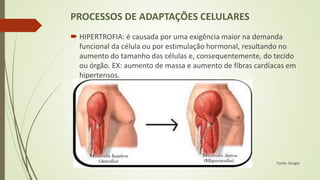 PROCESSOS DE ADAPTAÇÕES CELULARES
 HIPERTROFIA: é causada por uma exigência maior na demanda
funcional da célula ou por estimulação hormonal, resultando no
aumento do tamanho das células e, consequentemente, do tecido
ou órgão. EX: aumento de massa e aumento de fibras cardíacas em
hipertensos.
Fonte: Google
 