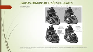 CAUSAS COMUNS DE LESÕES CELULARES
EX: HIPÓXIA
Fonte: Disponível em: <http://ebsco. smartimagebase.com/redu%C3%A7%C3%A3oem- fragmento-de-eje%C3%A7%C3%A3o/viewitem? ItemID=27618>.
Acesso em: 30 maio 2015
 