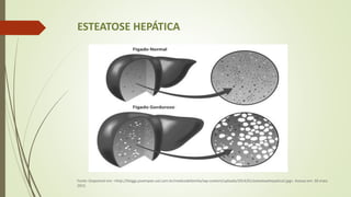 ESTEATOSE HEPÁTICA
Fonte: Disponível em: <http://blogjp.jovempan.uol.com.br/medicodefamilia/wp-content/uploads/2014/01/esteatosehepatica2.jpg>. Acesso em: 30 maio
2015.
 