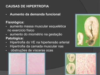 CAUSAS DE HIPERTROFIA

•   Aumento da demanda funcional

Fisiológica:
• aumento massa muscular esquelética
  no exercício físico
• aumento do miométrio na gestação
Patológica:
• Hipertrofia do VE na hipertensão arterial
• Hipertrofia da camada muscular nas
•   obstruções de vísceras ocas
 