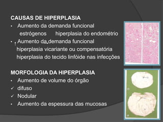 CAUSAS DE HIPERPLASIA
• Aumento da demanda funcional
   estrógenos      hiperplasia do endométrio
• Aumento da demanda funcional
  hiperplasia vicariante ou compensatória
  hiperplasia do tecido linfóide nas infecções

MORFOLOGIA DA HIPERPLASIA
• Aumento de volume do órgão
 difuso
 Nodular
• Aumento da espessura das mucosas
 