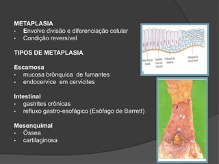 METAPLASIA
• Envolve divisão e diferenciação celular
• Condição reversível

TIPOS DE METAPLASIA

Escamosa
•  mucosa brônquica de fumantes
•  endocervice em cervicites

Intestinal
•   gastrites crônicas
•   refluxo gastro-esofágico (Esôfago de Barrett)

Mesenquimal
• Óssea
• cartilaginosa
 