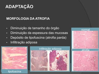 ADAPTAÇÃO

MORFOLOGIA DA ATROFIA

•     Diminuição de tamanho do órgão            normal
•     Diminuição da espessura das mucosas
•     Depósito de lipofuscina (atrofia parda)
•     Infiltração adiposa
                         Infiltração adiposa    atrofia




    lipofuscina
 