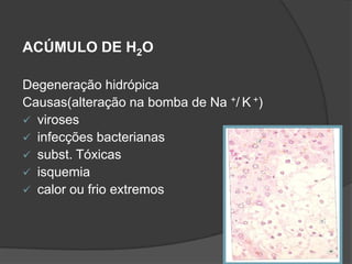 ACÚMULO DE H2O

Degeneração hidrópica
Causas(alteração na bomba de Na +/ K +)
 viroses
 infecções bacterianas
 subst. Tóxicas
 isquemia
 calor ou frio extremos
 