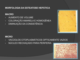 MORFOLOGIA DA ESTEATOSE HEPÁTICA

MACRO
• AUMENTO DE VOLUME
• COLORAÇÃO AMARELA E HOMOGÊNEA
• DIMINUIÇÃO DA CONSISTÊNCIA




MICRO
•  VACÚOLOS CITOPLASMÁTICOS OPTICAMENTE VAZIOS
•  NÚCLEO RECHAÇADO PARA PERIFERIA
 