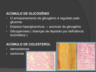 ACÚMULO DE GLICOGÊNIO
• O armazenamento de glicogênio é regulado pela
  glicemia
• Estados hiperglicemicos  acúmulo de glicogênio
• Glicogenoses ( doenças de depósito por deficiência
  enzimática )

ACÚMULO DE COLESTEROL
• aterosclerose
• xantomas
 