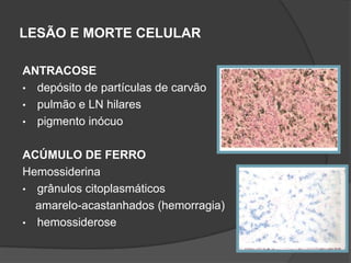 LESÃO E MORTE CELULAR

ANTRACOSE
• depósito de partículas de carvão
• pulmão e LN hilares
• pigmento inócuo


ACÚMULO DE FERRO
Hemossiderina
• grânulos citoplasmáticos
  amarelo-acastanhados (hemorragia)
• hemossiderose
 