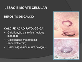 LESÃO E MORTE CELULAR

DÉPOSITO DE CALCIO



CALCIFICAÇÃO PATOLÓGICA:
• Calcificação distrófica (tecidos
  lesados)
• Calcificação metastática
  (hipercalcemia)
• Cálculos( vesícula, rim,bexiga )
 