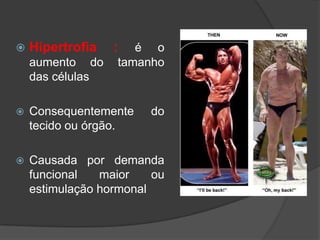    Hipertrofia   :   é o
    aumento do     tamanho
    das células

   Consequentemente    do
    tecido ou órgão.

   Causada por demanda
    funcional   maior    ou
    estimulação hormonal
 