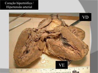 Coração hipertrófica /
Hipertensão arterial
VE
VD
 