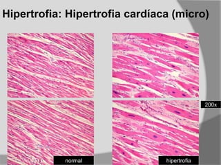 Hipertrofia: Hipertrofia cardíaca (micro)
normal hipertrofia
200x
 