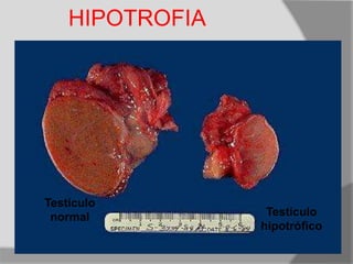 Testículo
normal Testículo
hipotrófico
HIPOTROFIA
 