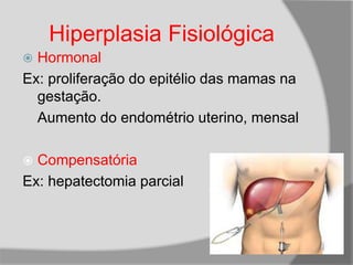 Hiperplasia Fisiológica
 Hormonal
Ex: proliferação do epitélio das mamas na
gestação.
Aumento do endométrio uterino, mensal
 Compensatória
Ex: hepatectomia parcial
 