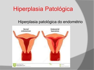 Hiperplasia Patológica
Hiperplasia patológica do endométrio
 