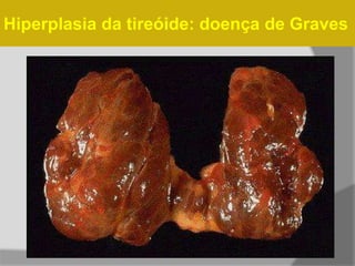 Hiperplasia da tireóide: doença de Graves
 