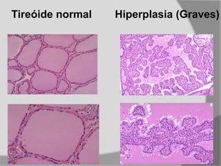 Tireóide normal Hiperplasia (Graves)
 
