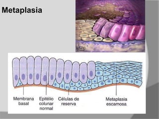 Metaplasia
 