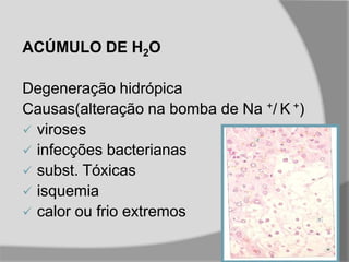 ACÚMULO DE H2O
Degeneração hidrópica
Causas(alteração na bomba de Na +/ K +)
 viroses
 infecções bacterianas
 subst. Tóxicas
 isquemia
 calor ou frio extremos
 