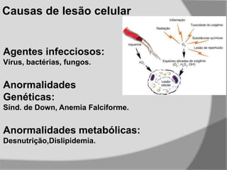 Agentes infecciosos:
Vírus, bactérias, fungos.
Anormalidades
Genéticas:
Sínd. de Down, Anemia Falciforme.
Anormalidades metabólicas:
Desnutrição,Dislipidemia.
Causas de lesão celular
 