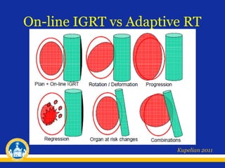 Adaptive Rt Example Adaptive radiotherapy | PPT