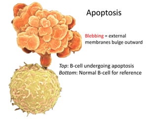 Apoptosis
Blebbing = external
membranes bulge outward
Top: B-cell undergoing apoptosis
Bottom: Normal B-cell for reference
 