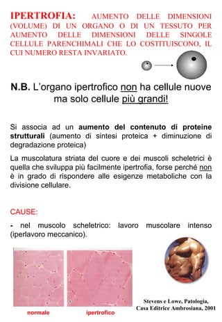 IPERTROFIA: AUMENTO DELLE DIMENSIONI
(VOLUME) DI UN ORGANO O DI UN TESSUTO PER
AUMENTO DELLE DIMENSIONI DELLE SINGOLE
CELLULE PARENCHIMALI CHE LO COSTITUISCONO, IL
CUI NUMERO RESTA INVARIATO.
N.B. L’organo ipertrofico non ha cellule nuove
ma solo cellule più grandi!
Si associa ad un aumento del contenuto di proteine
strutturali (aumento di sintesi proteica + diminuzione di
degradazione proteica)
La muscolatura striata del cuore e dei muscoli scheletrici è
quella che sviluppa più facilmente ipertrofia, forse perché non
è in grado di rispondere alle esigenze metaboliche con la
divisione cellulare.
CAUSE:
- nel muscolo scheletrico: lavoro muscolare intenso
(iperlavoro meccanico).
normale ipertrofico
Stevens e Lowe, Patologia,
Casa Editrice Ambrosiana, 2001
 